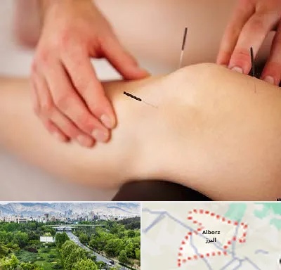 دکتر طب سوزنی برای لاغری در البرز