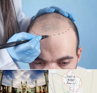 کاشت مو اقساطی در آران و بیدگل