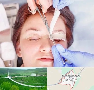 جراحی پلک افتاده در مشگین شهر