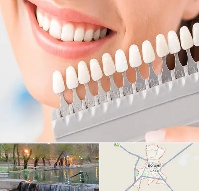 متخصص لمینت دندان در بروجن