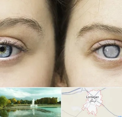 متخصص آب سیاه (گلوکوم) در لردگان