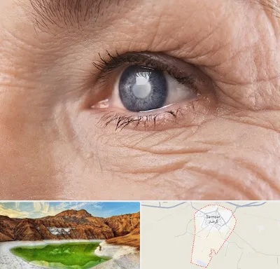 متخصص آب مروارید در گرمسار