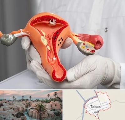 دکتر سرطان رحم در طبس