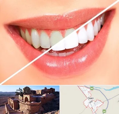 بلیچینگ دندان در قائن