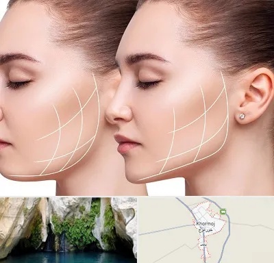 جراحی بوکال فت در خورموج