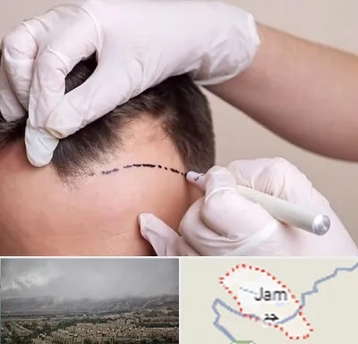 کاشت مو به روش SUT در جم