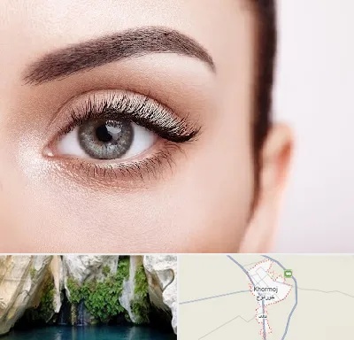 فوق تخصص عنبیه در خورموج