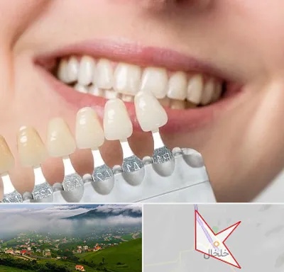 مرکز کامپوزیت دندان در خلخال
