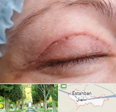 جراح پلک در استهبان