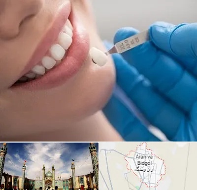 مرکز لمینت دندان در آران و بیدگل