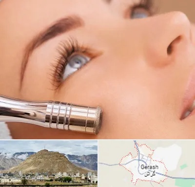 میکرودرم در گراش
