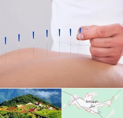 دکتر طب سوزنی در املش