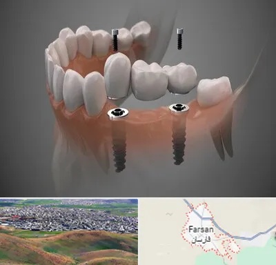 ایمپلنت دیجیتال در فارسان