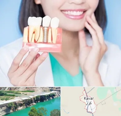 متخصص ایمپلنت در کوار