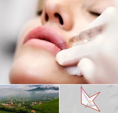 کلینیک تزریق ژل لب در خلخال