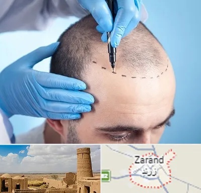 دکتر کاشت مو در زرند