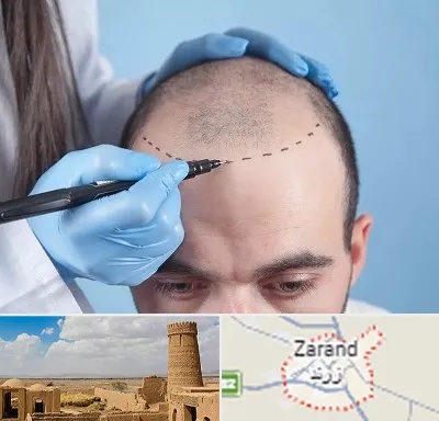 کاشت مو اقساطی در زرند