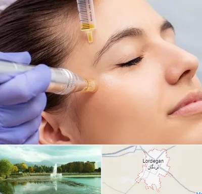 میکرونیدلینگ در لردگان