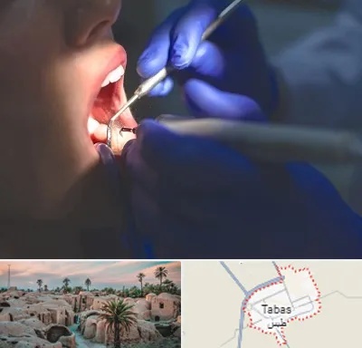 عصب کشی در طبس