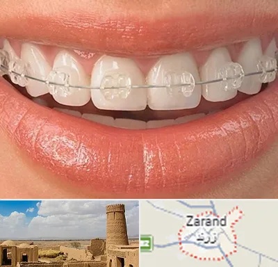 ارتودنسی اقساطی در زرند
