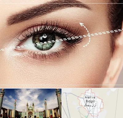 جراحی چشم گربه ای در آران و بیدگل
