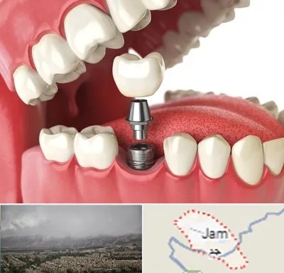 متخصص پروتز دندان در جم