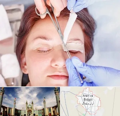 جراحی پلک افتاده در آران و بیدگل