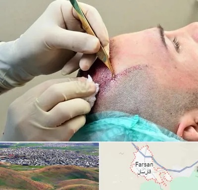 کلینیک کاشت مو در فارسان