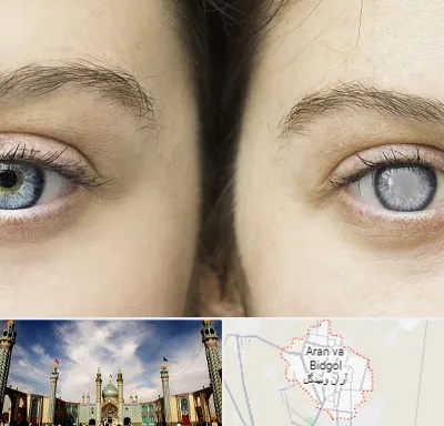 متخصص آب سیاه (گلوکوم) در آران و بیدگل
