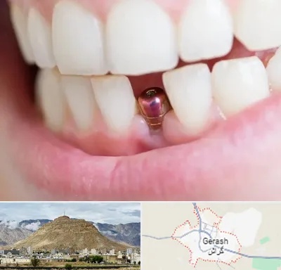 ایمپلنت اقساطی در گراش