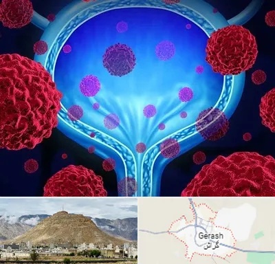 دکتر سرطان مثانه در گراش