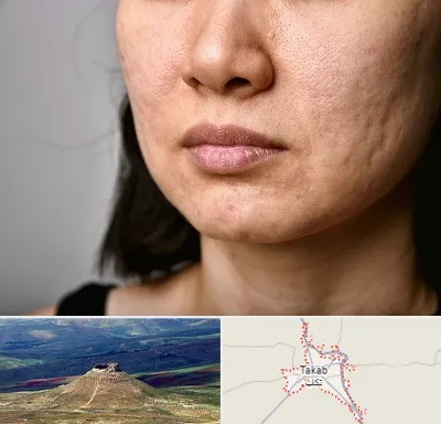 سابسیژن جای جوش در تکاب