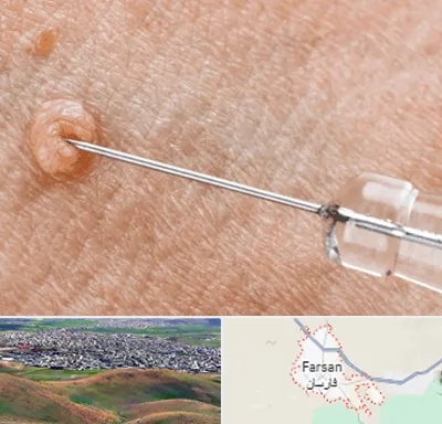 لیزر زگیل تناسلی در فارسان
