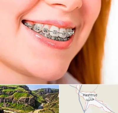 ارتودنسی ارزان در هشترود