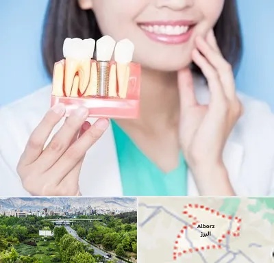 متخصص ایمپلنت در البرز