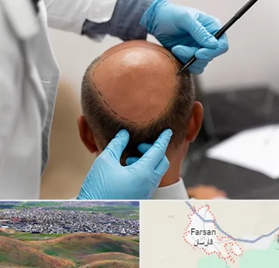 آموزش کاشت مو در فارسان