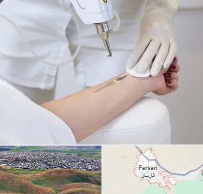 پاک کردن تتو با لیزر در فارسان
