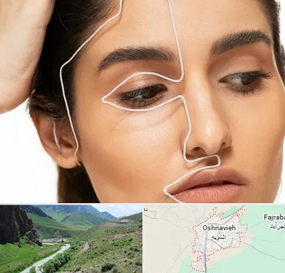 عمل بینی اقساطی در اشنویه