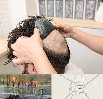 پروتز مو در بروجن
