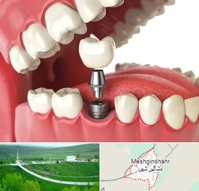 متخصص پروتز دندان در مشگین شهر
