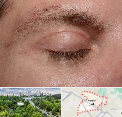 جراح بلفاروپلاستی در البرز
