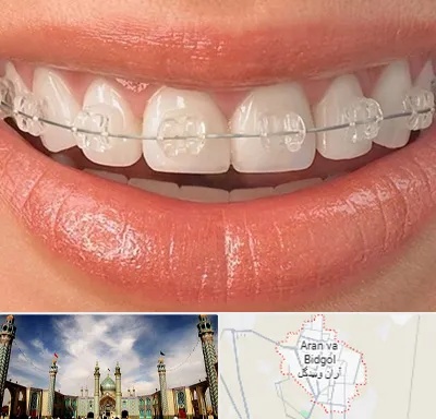 ارتودنسی اقساطی در آران و بیدگل