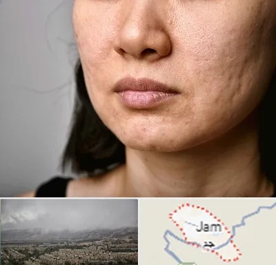 سابسیژن جای جوش در جم