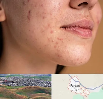 درمان جای جوش در فارسان