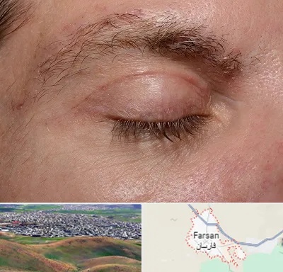جراح بلفاروپلاستی در فارسان
