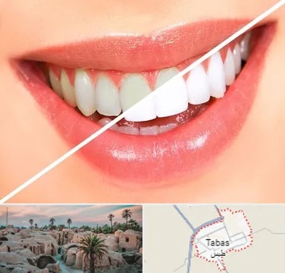 بلیچینگ دندان در طبس