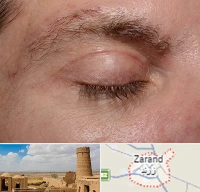 جراح بلفاروپلاستی در زرند