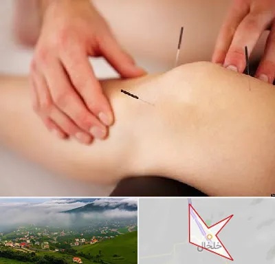 دکتر طب سوزنی برای لاغری در خلخال