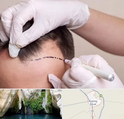 کاشت مو به روش SUT در خورموج