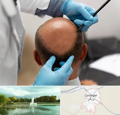 آموزش کاشت مو در لردگان